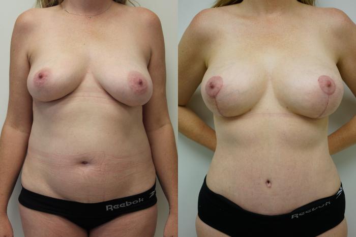 Before & After Breast Lift (No Implants) Case 435 Front View in Gilbert, AZ