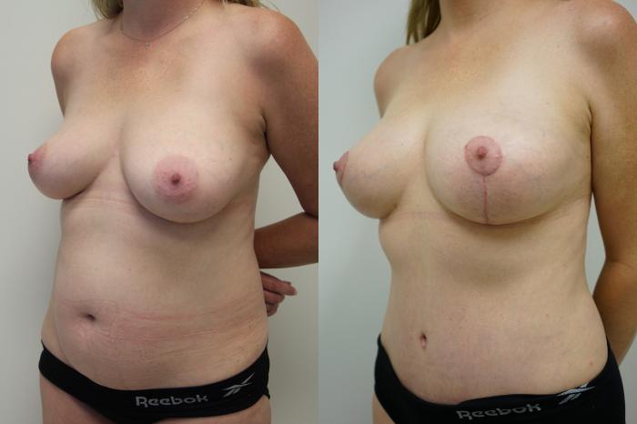 Before & After Breast Lift (No Implants) Case 435 Left Oblique View in Gilbert, AZ