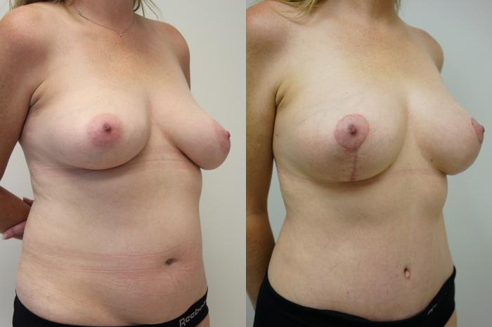Before & After Breast Lift (No Implants) Case 435 Right Oblique View in Gilbert, AZ