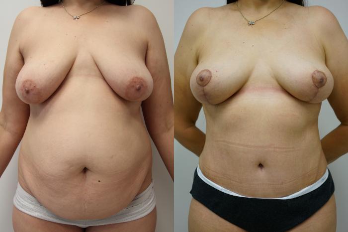 Before & After Tummy Tuck (Abdominoplasty) Case 436 Front View in Gilbert, AZ