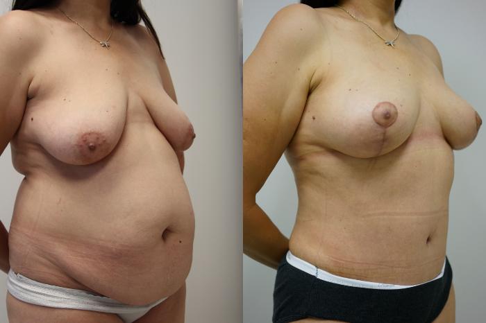 Before & After Tummy Tuck (Abdominoplasty) Case 436 Right Oblique View in Gilbert, AZ