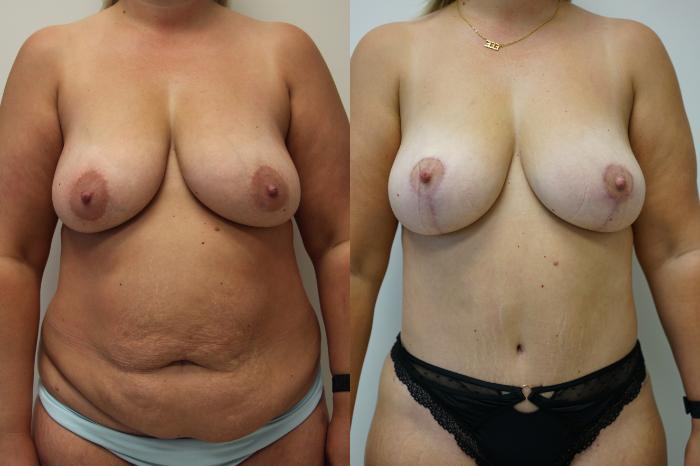 Before & After Tummy Tuck (Abdominoplasty) Case 437 Front View in Gilbert, AZ