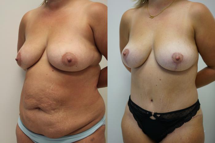 Before & After Tummy Tuck (Abdominoplasty) Case 437 Left Oblique View in Gilbert, AZ