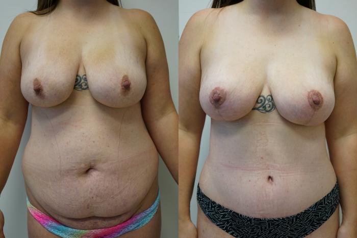 Before & After Tummy Tuck (Abdominoplasty) Case 440 Front View in Gilbert, AZ