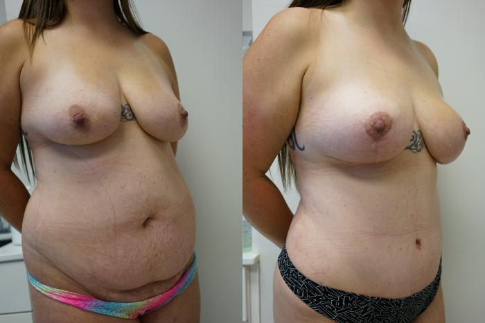 Before & After Tummy Tuck (Abdominoplasty) Case 440 Right Oblique View in Gilbert, AZ