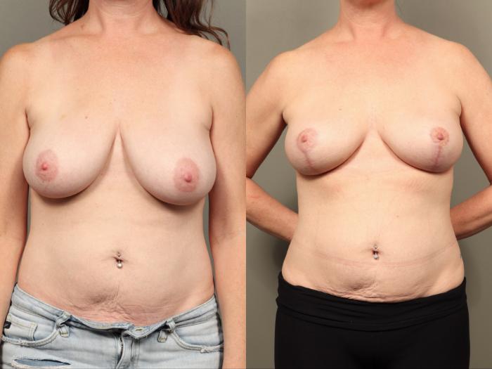 Before & After Breast Lift (No Implants) Case 503 Front View in Gilbert, AZ