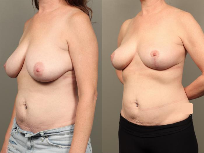 Before & After Breast Lift (No Implants) Case 503 Left Oblique View in Gilbert, AZ