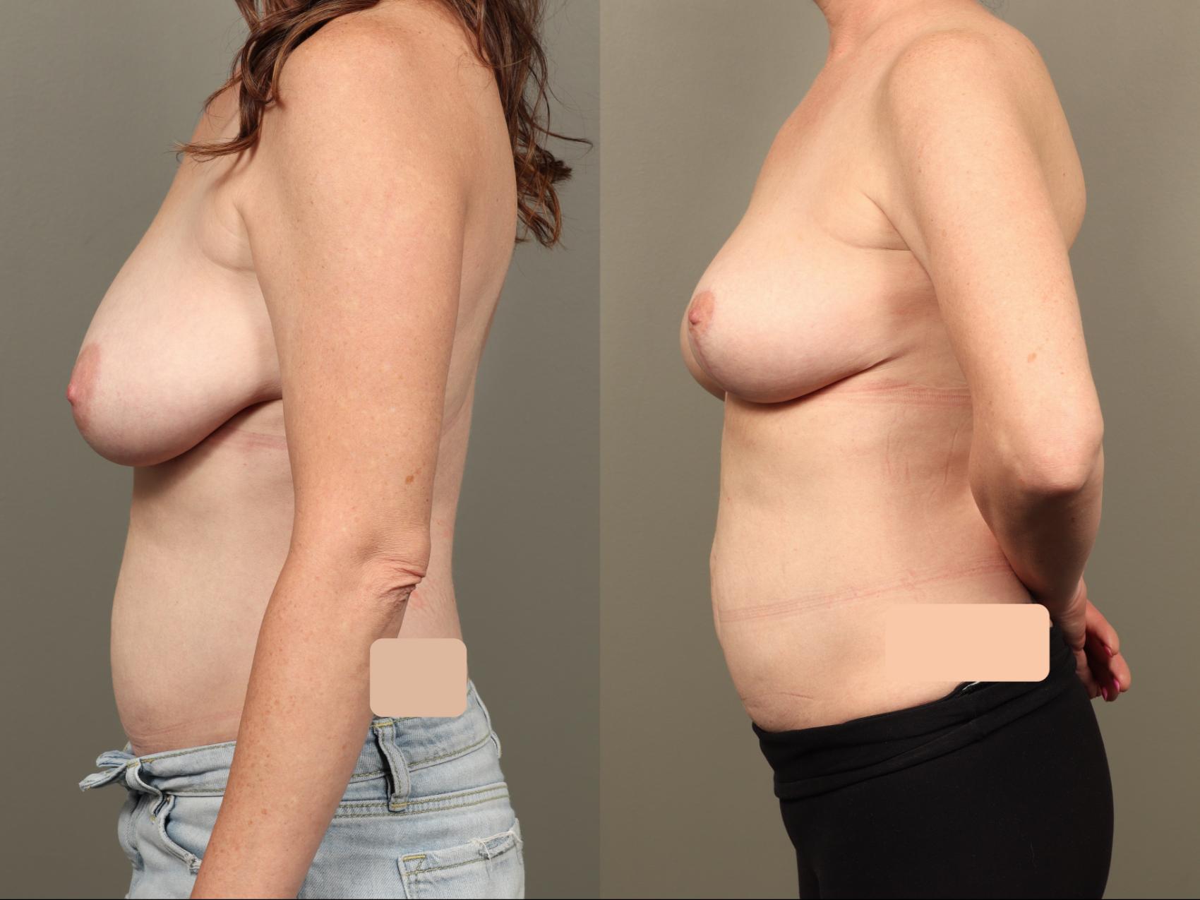 Before & After Breast Lift (No Implants) Case 503 Left Side View in Gilbert, AZ