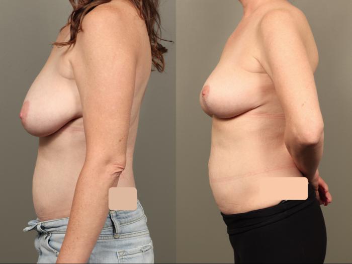 Before & After Breast Lift (No Implants) Case 503 Left Side View in Gilbert, AZ
