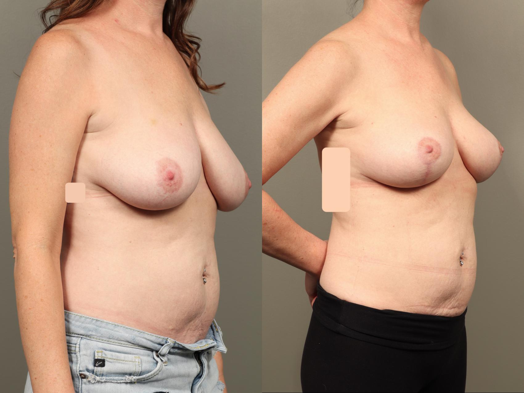 Before & After Breast Lift (No Implants) Case 503 Right Oblique View in Gilbert, AZ