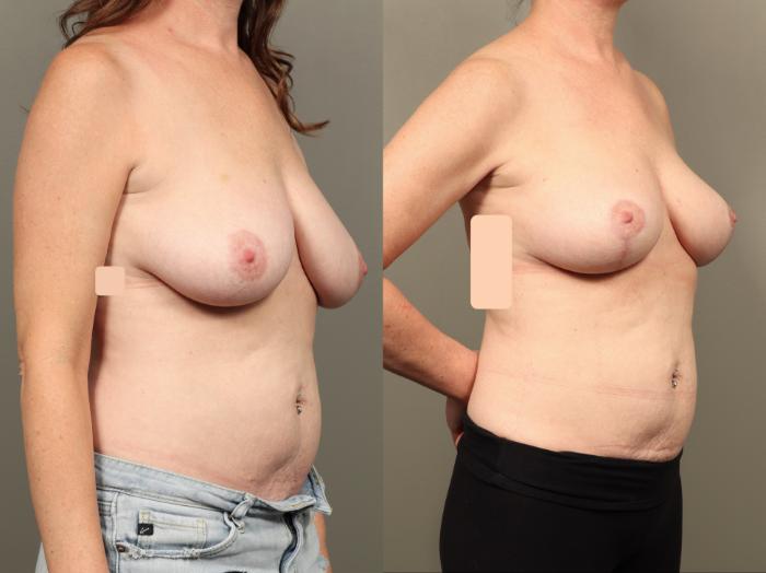 Before & After Breast Lift (No Implants) Case 503 Right Oblique View in Gilbert, AZ