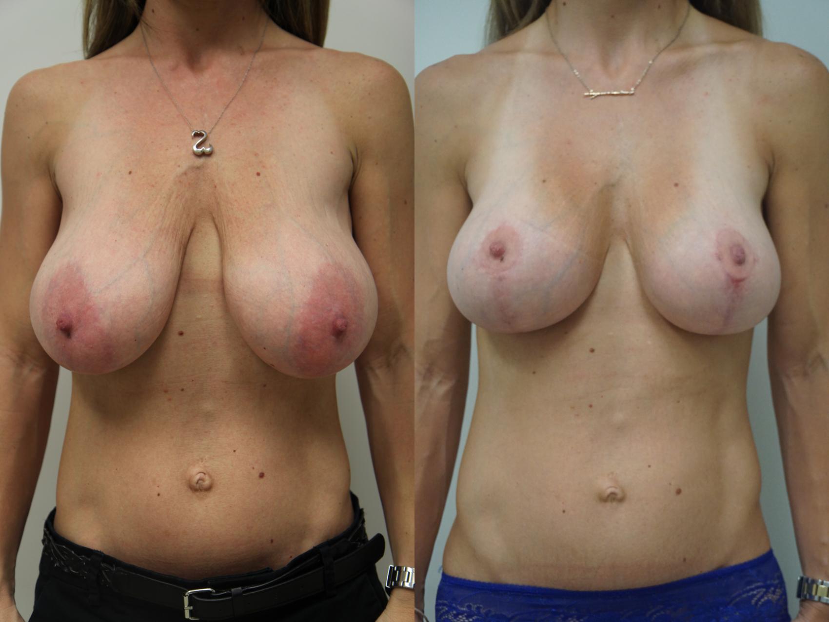 Before & After Breast Lift (No Implants) Case 86 View #1 View in Gilbert, AZ