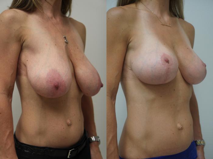 Before & After Breast Lift (No Implants) Case 86 View #2 View in Gilbert, AZ