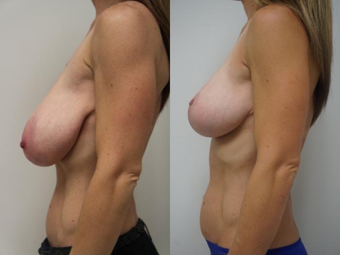 Before & After Breast Lift (No Implants) Case 86 View #3 View in Gilbert, AZ