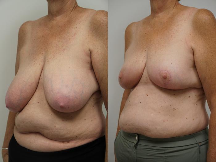 Before & After Breast Reduction Case 106 View #1 View in Gilbert, AZ