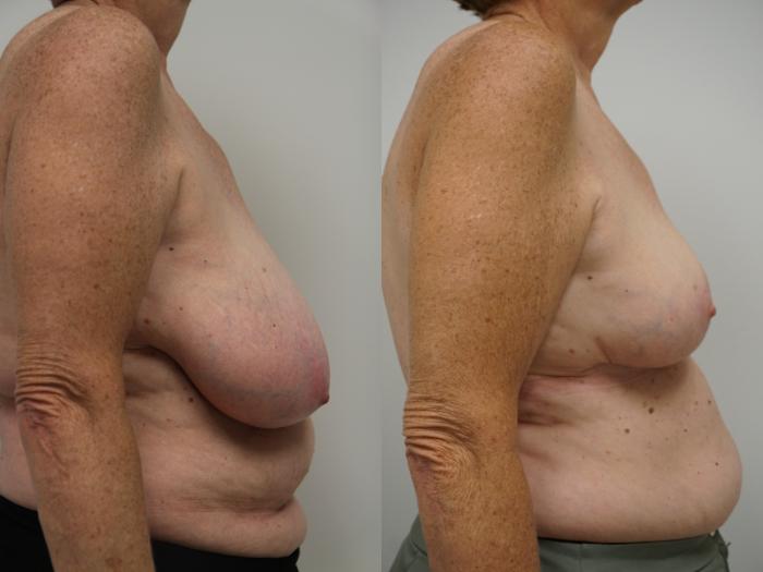 Before & After Breast Reduction Case 106 View #2 View in Gilbert, AZ