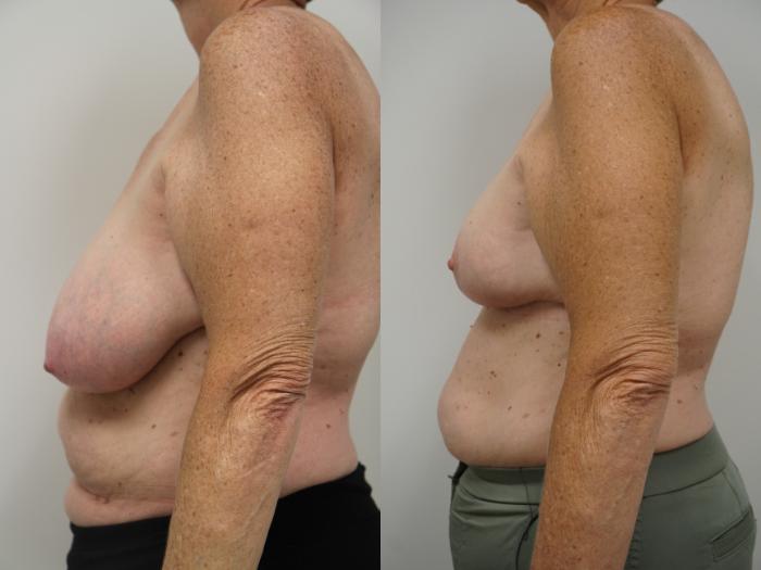 Before & After Breast Reduction Case 106 View #3 View in Gilbert, AZ