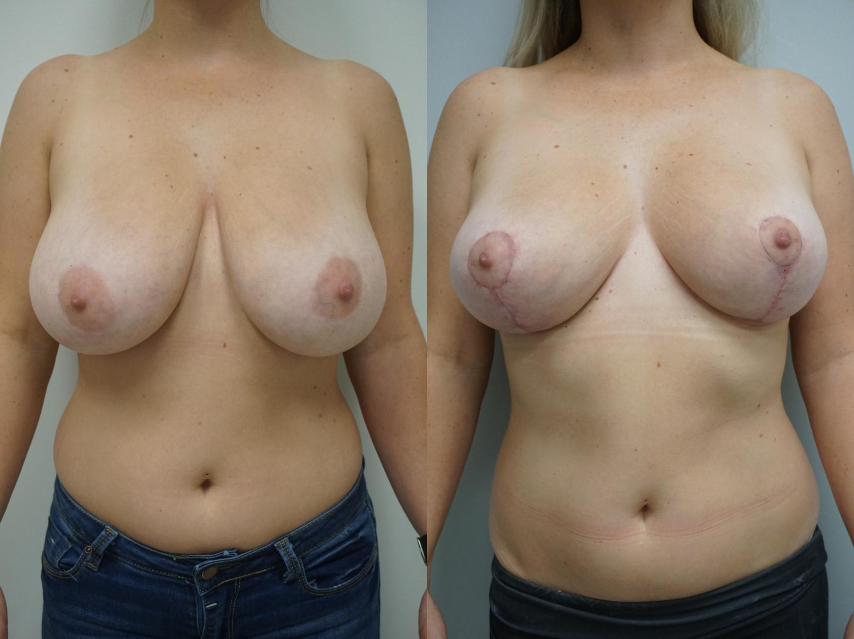 Before & After Breast Reduction Case 163 View #1 View in Gilbert, AZ