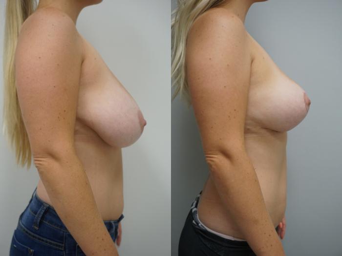Before & After Breast Reduction Case 163 View #2 View in Gilbert, AZ
