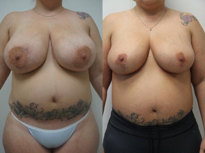 Before & After Breast Reduction Case 191 View #1 View in Gilbert, AZ