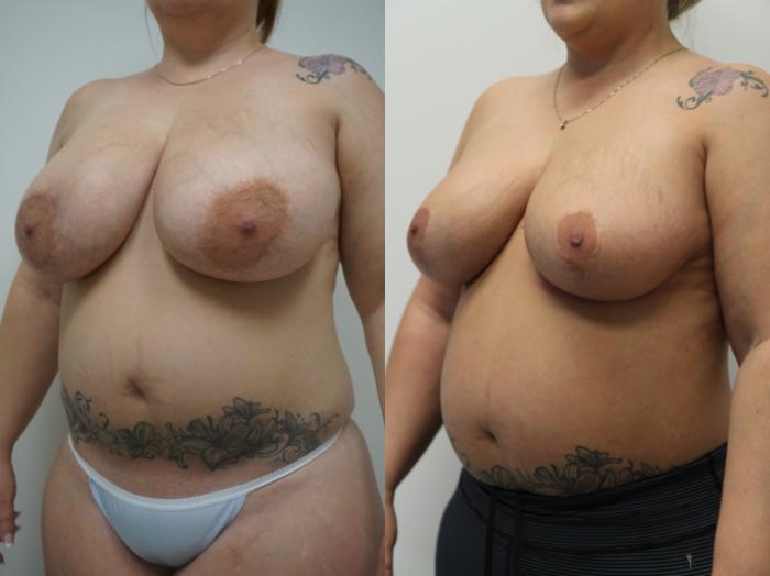 Before & After Breast Reduction Case 191 View #2 View in Gilbert, AZ