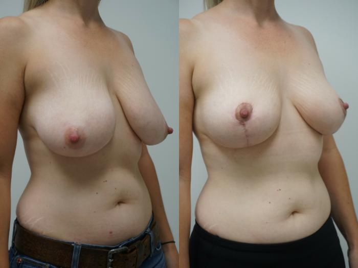 Before & After Breast Reduction Case 229 View #2 View in Gilbert, AZ
