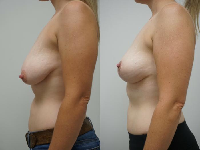 Before & After Breast Reduction Case 229 View #3 View in Gilbert, AZ
