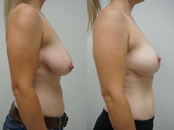 Before & After Breast Reduction Case 229 View #4 View in Gilbert, AZ