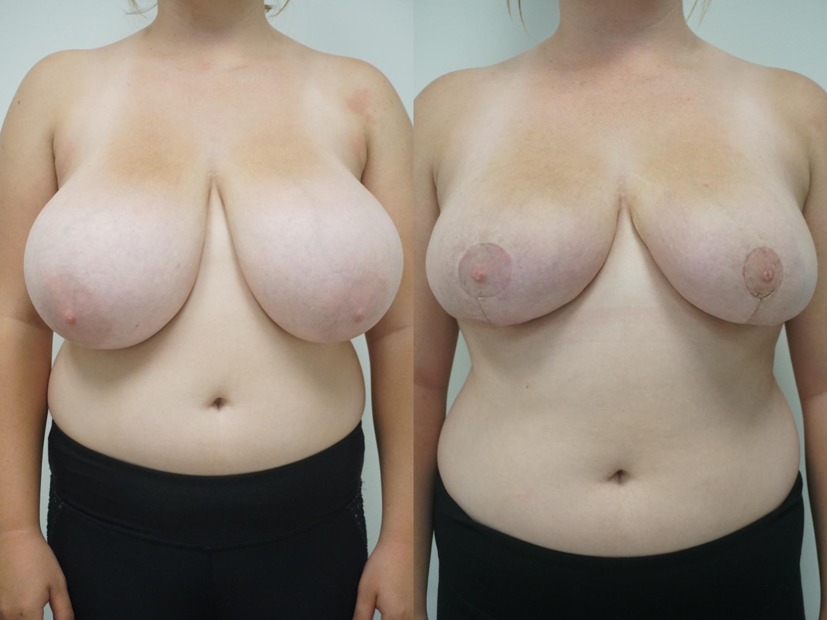 Before & After Breast Reduction Case 91 View #1 View in Gilbert, AZ