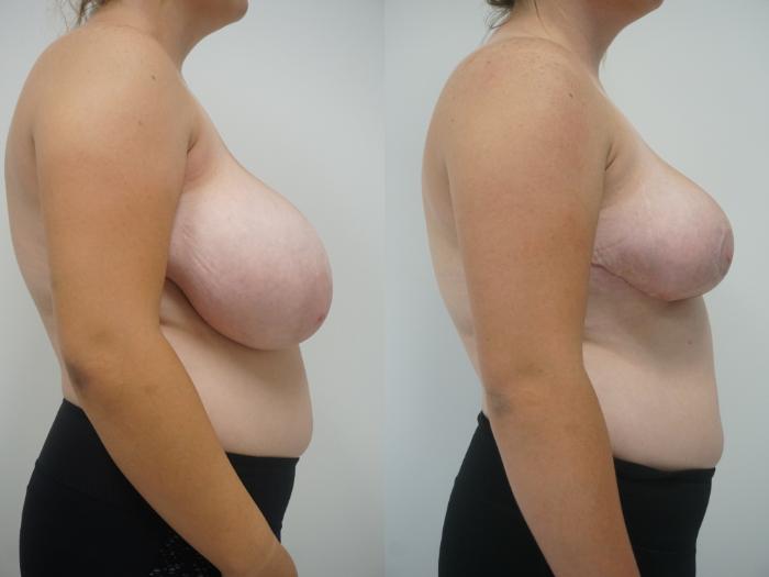 Before & After Breast Reduction Case 91 View #3 View in Gilbert, AZ