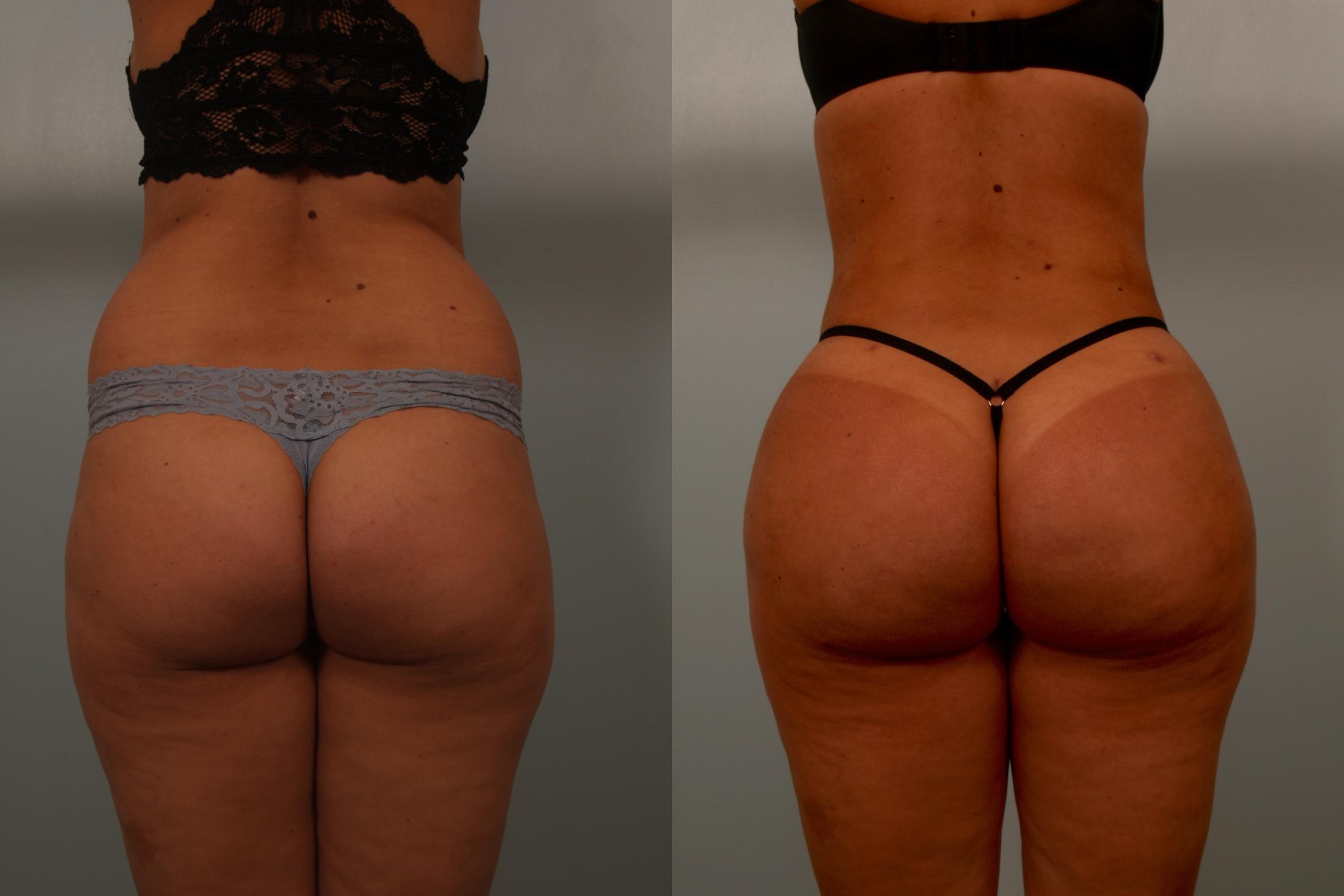 Before & After Brazilian Buttock Lift Case 119 View #1 View in Gilbert, AZ