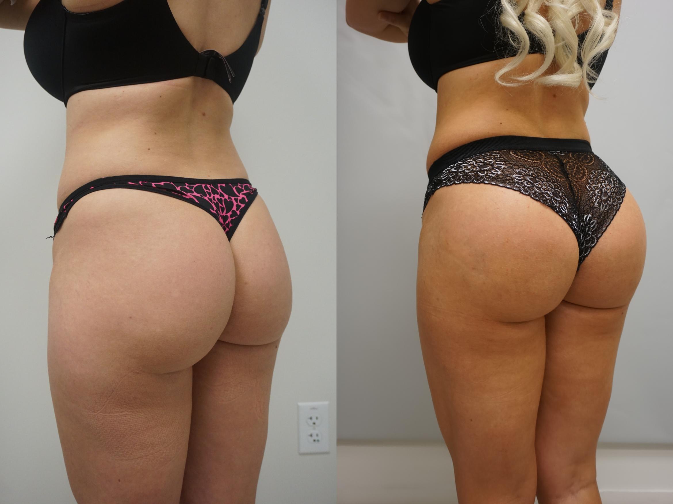 Before & After Brazilian Buttock Lift Case 154 View #1 View in Gilbert, AZ