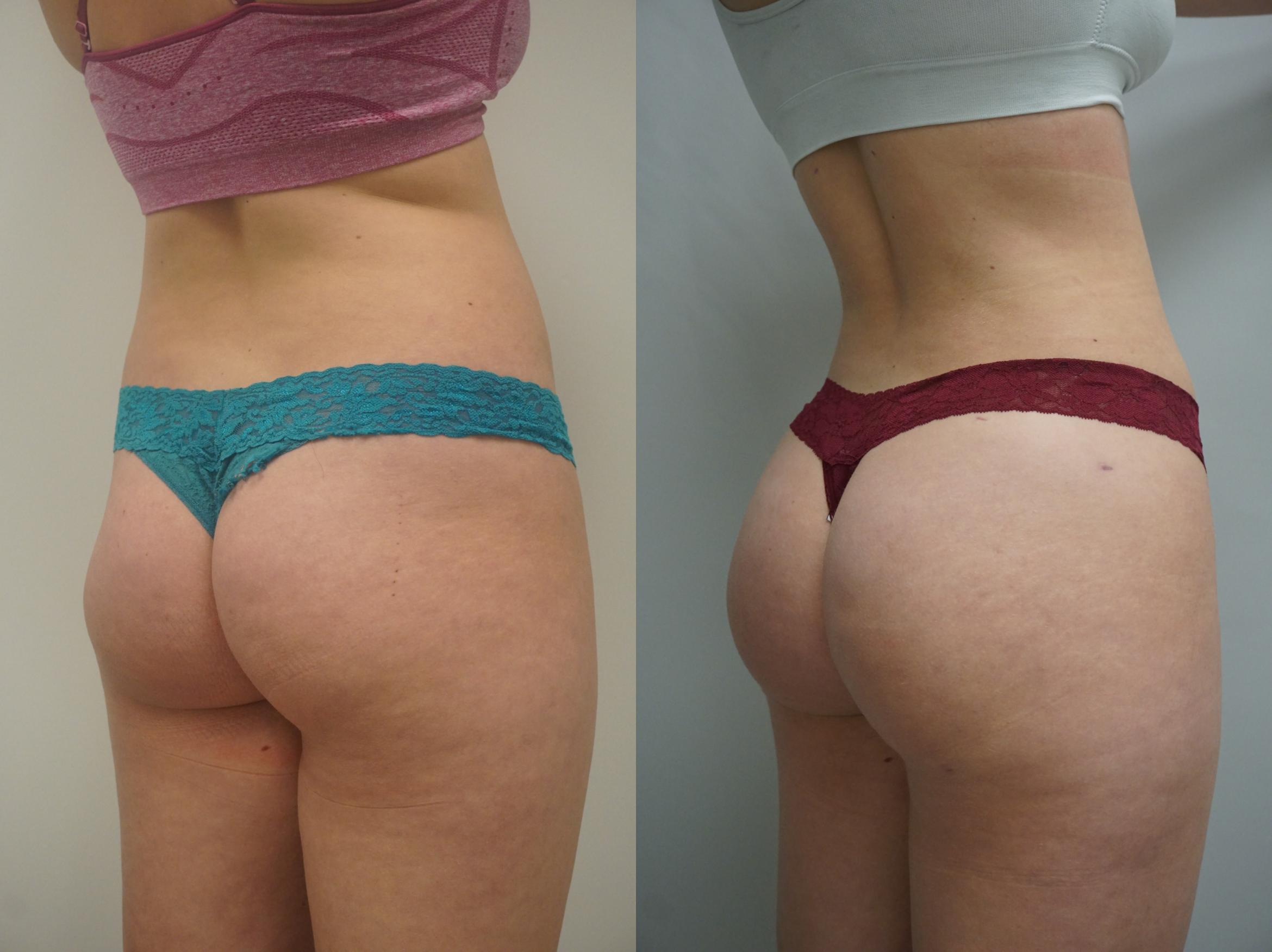 brazilian butt lift workout before after