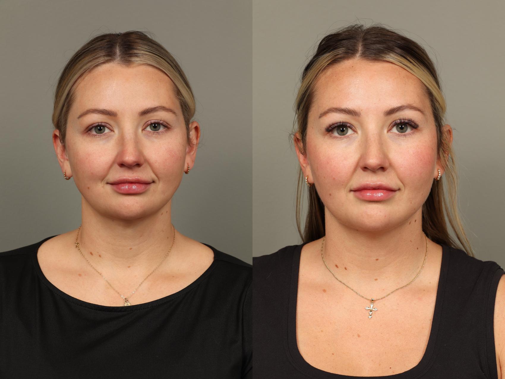 Before & After Chin Augmentation Case 493 Front View in Gilbert, AZ