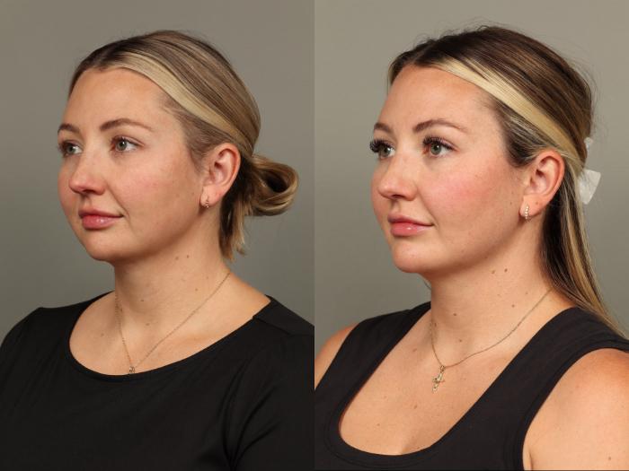 Before & After Chin Augmentation Case 493 Left Oblique View in Gilbert, AZ