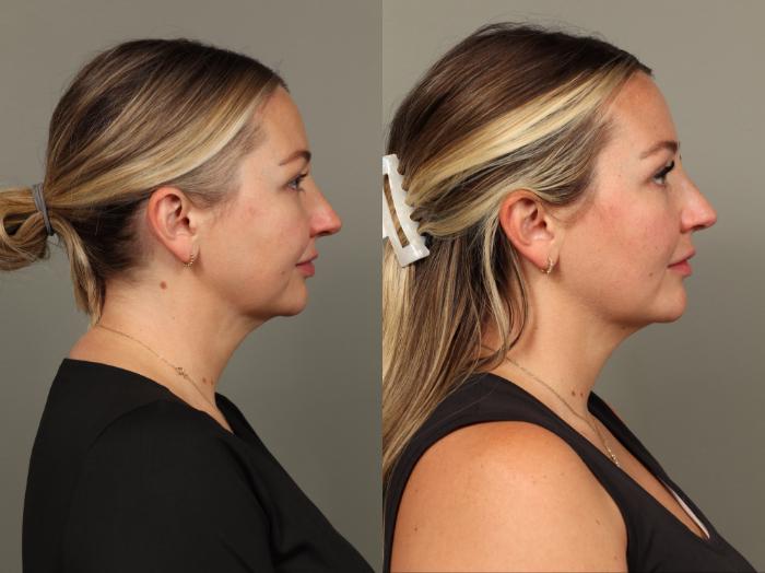 Before & After Chin Augmentation Case 493 Left Side View in Gilbert, AZ