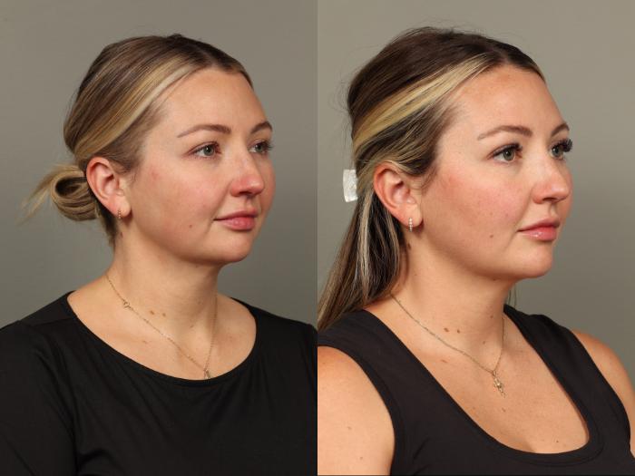 Before & After Chin Augmentation Case 493 Right Oblique View in Gilbert, AZ