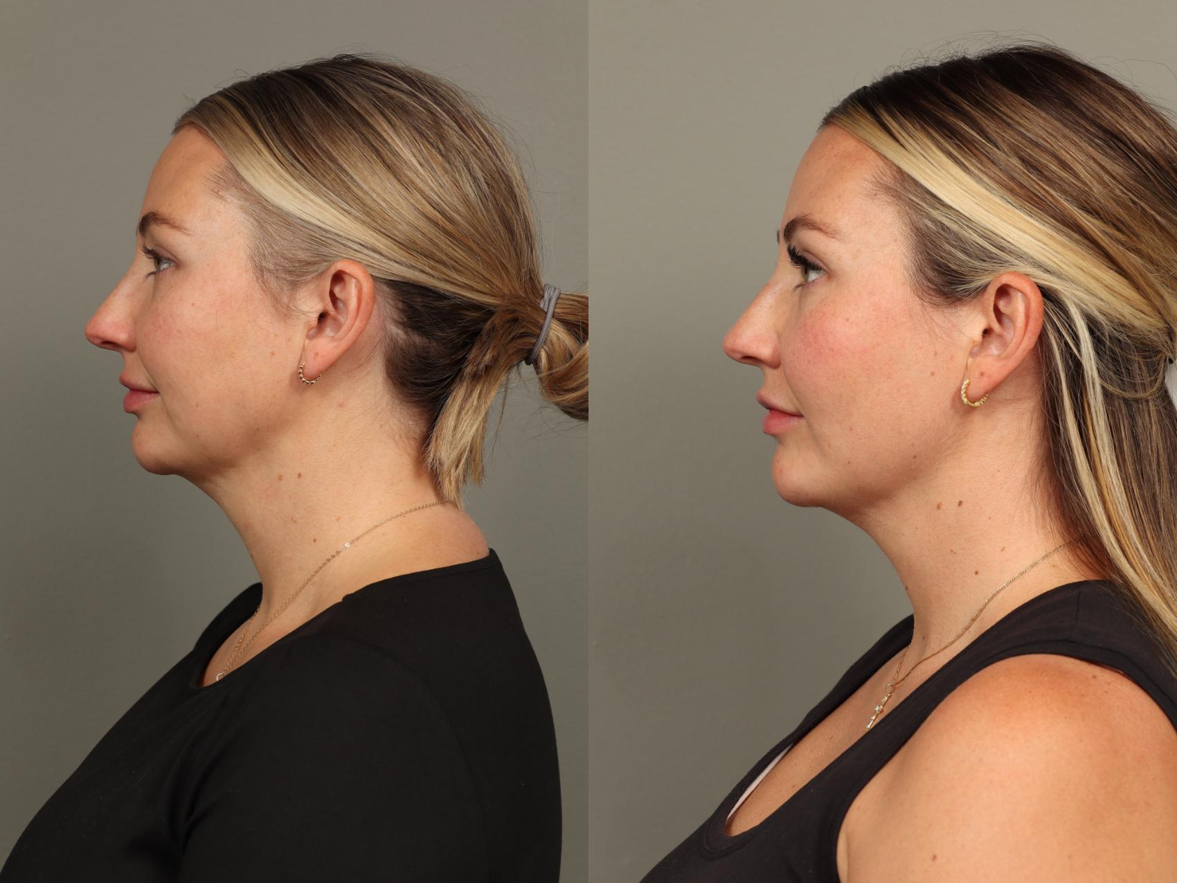 Before & After Chin Augmentation Case 493 Right Side View in Gilbert, AZ