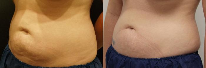 Before & After Coolsculpting Case 20 View #2 View in Gilbert, AZ