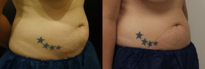 Before & After Coolsculpting Case 20 View #3 View in Gilbert, AZ