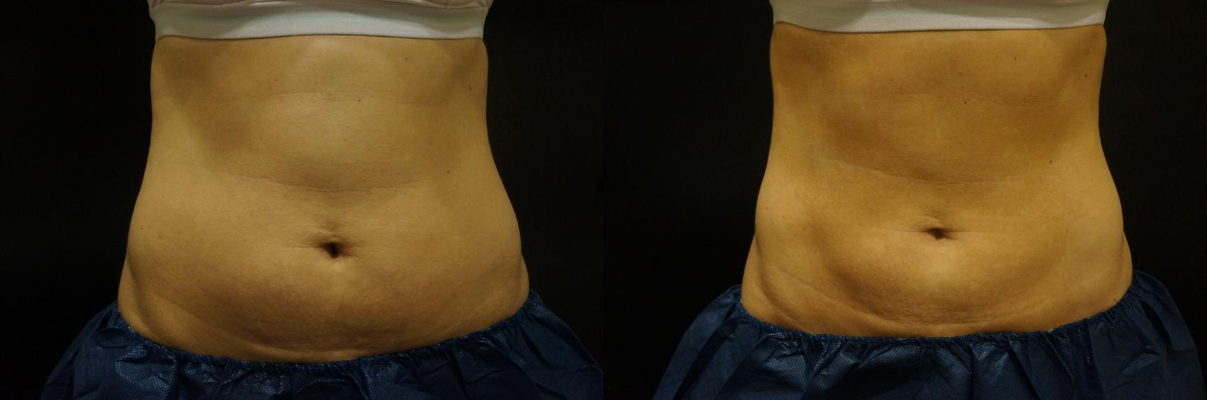 Before & After Coolsculpting Case 21 View #1 View in Gilbert, AZ