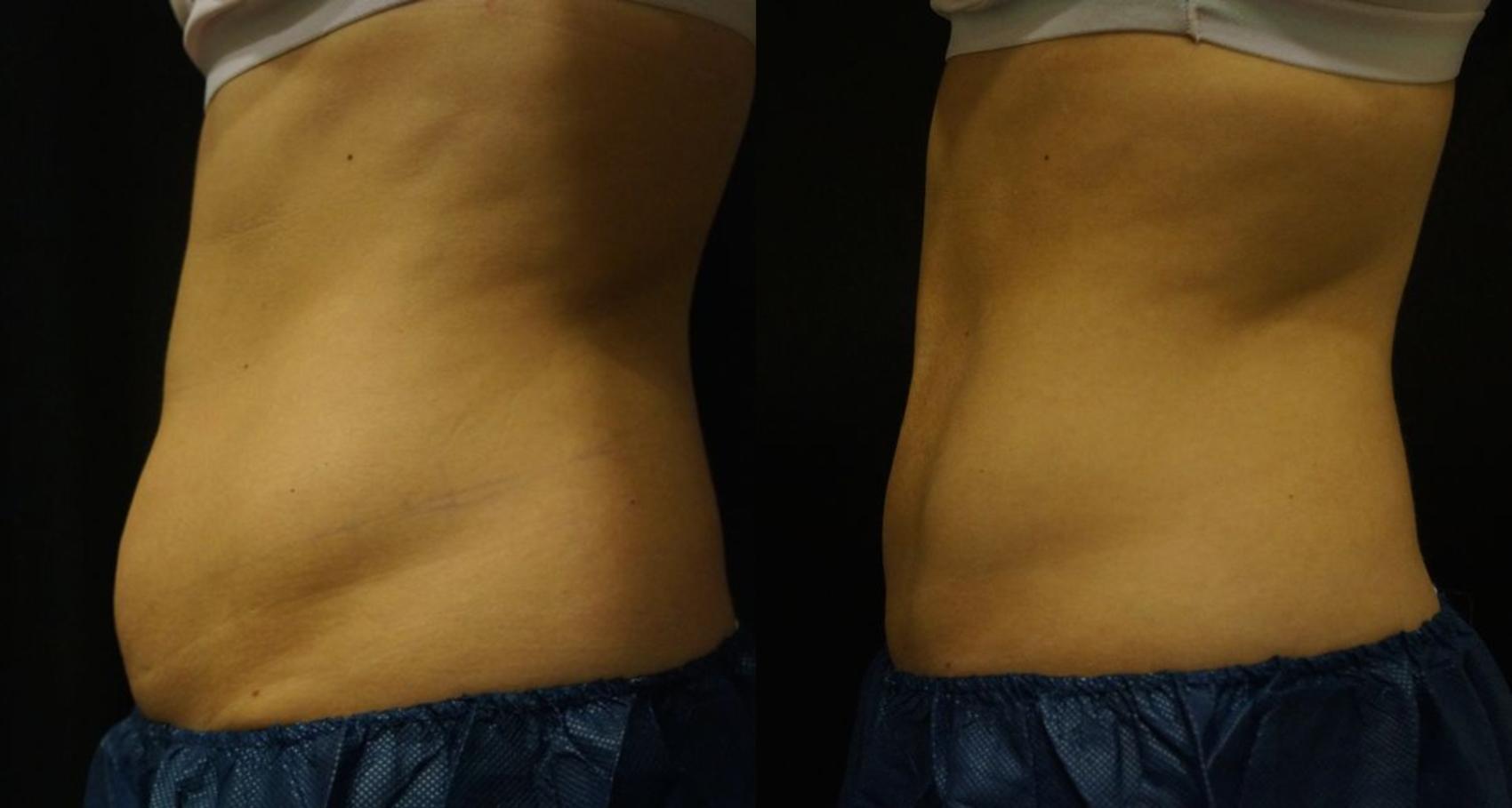 Before & After Coolsculpting Case 21 View #2 View in Gilbert, AZ