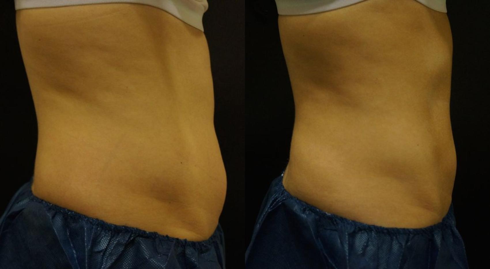 Before & After Coolsculpting Case 21 View #3 View in Gilbert, AZ