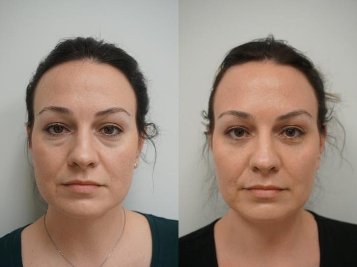 Before & After Eyelid Surgery Case 104 View #2 View in Gilbert, AZ