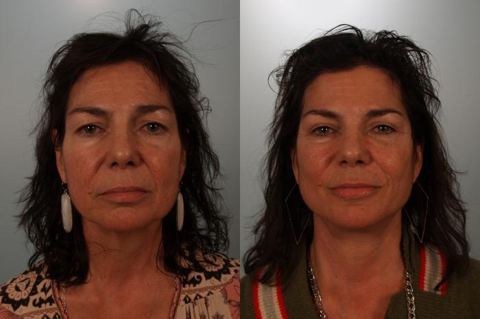 Before & After Eyelid Surgery Case 153 View #1 View in Gilbert, AZ