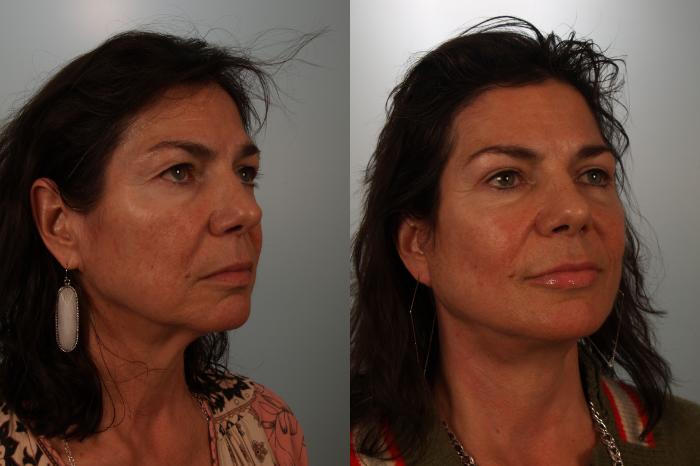 Before & After Eyelid Surgery Case 153 View #2 View in Gilbert, AZ