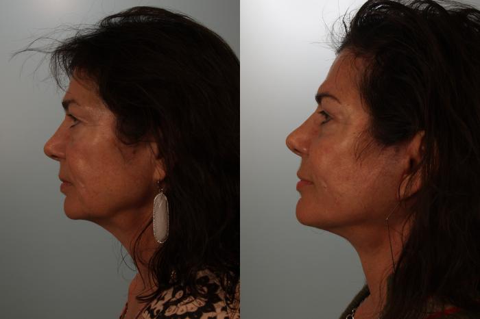 Before & After Eyelid Surgery Case 153 View #3 View in Gilbert, AZ