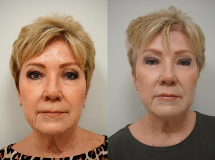 Before & After Eyelid Surgery Case 158 View #1 View in Gilbert, AZ