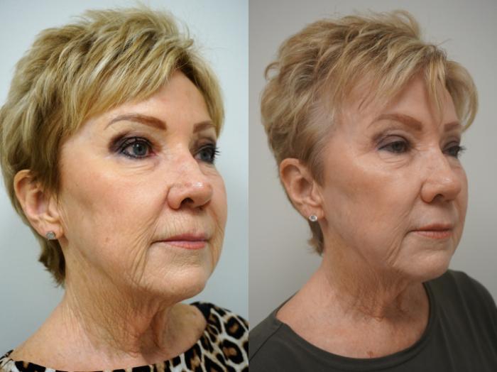 Before & After Eyelid Surgery Case 158 View #2 View in Gilbert, AZ
