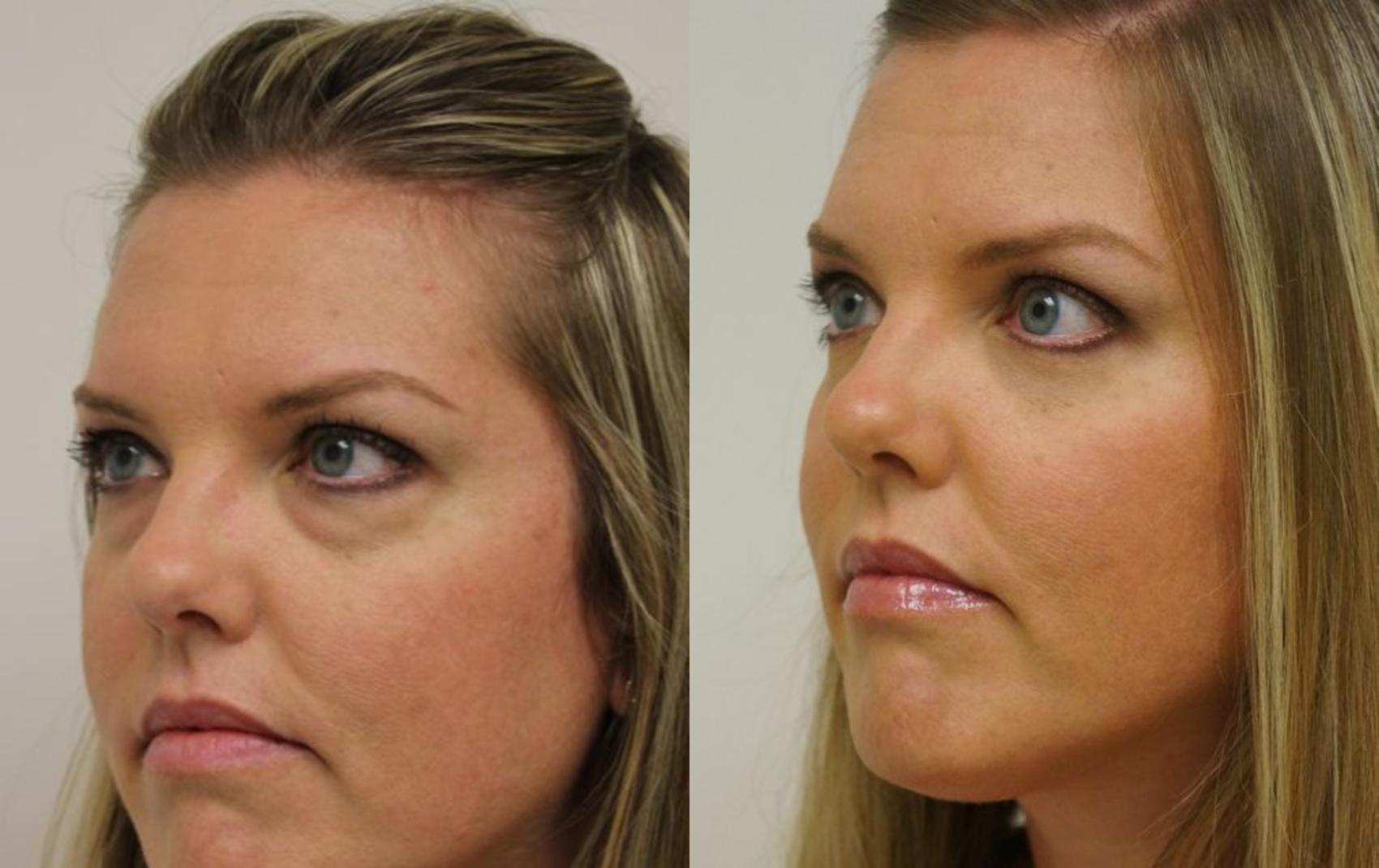 Before & After Eyelid Surgery Case 31 View #1 View in Gilbert, AZ